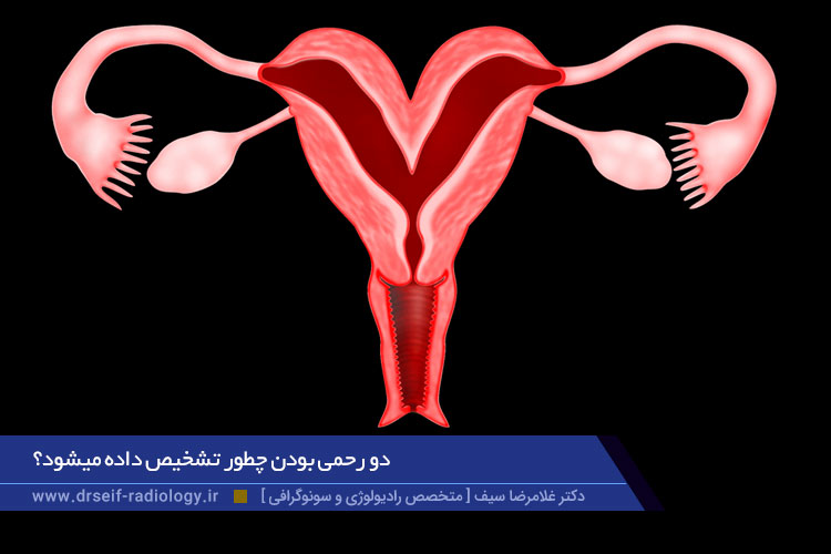 دو رحمی بودن