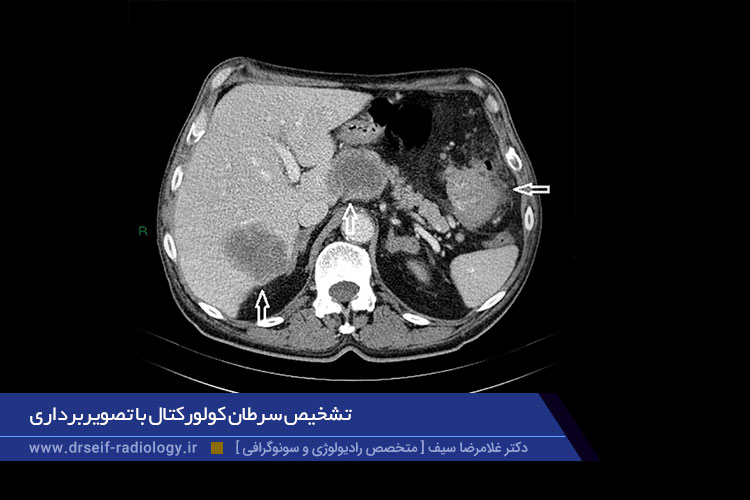 سرطان کولورکتال