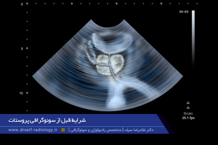 سونوگرافی پروستات