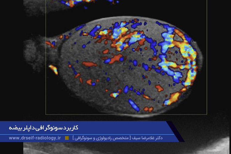 کاربرد سونوگرافی داپلر بیضه 