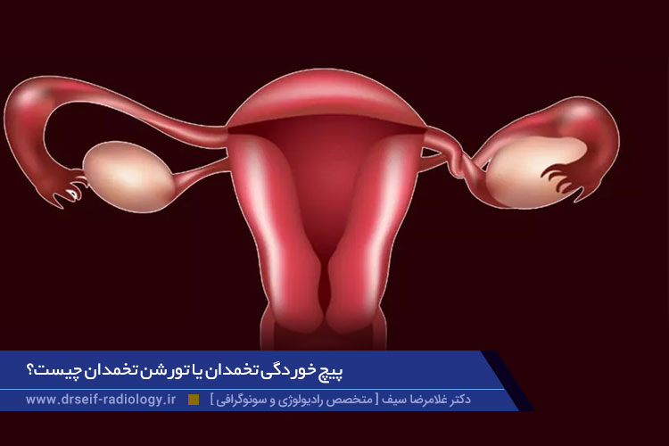 علائم تورشن یا پیچ خوردگی تخمدان