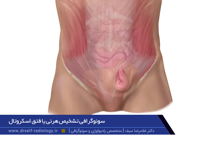 سونوگرافی تشخیص هرنی یا فتق اسکروتال