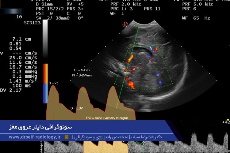 سونوگرافی داپلر عروق مغز