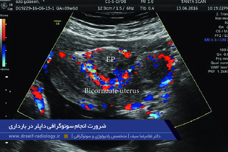 سونوگرافی داپلر در بارداری
