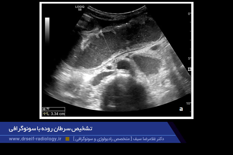 تشخیص سرطان روده با سونوگرافی