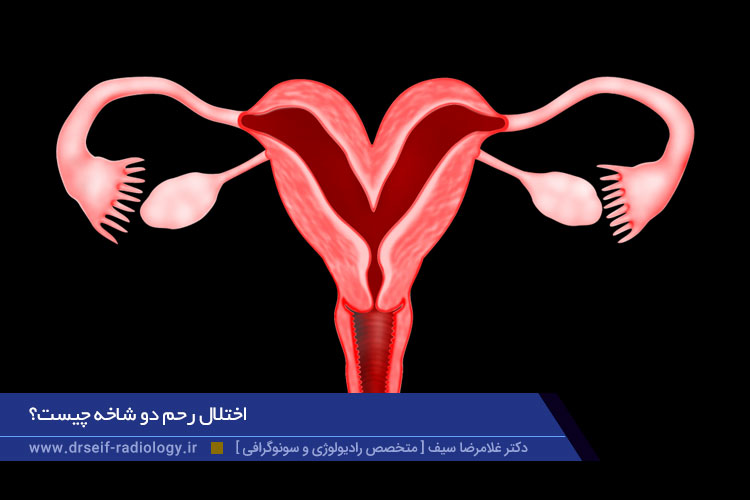 اختلال رحم دو شاخه چیست؟