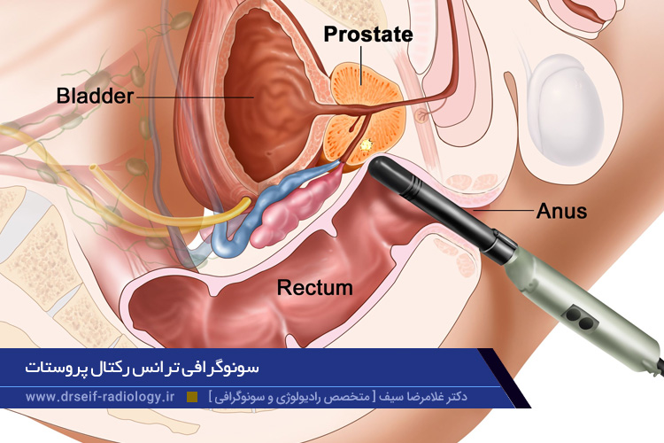 سونوگرافی ترانس رکتال پروستات