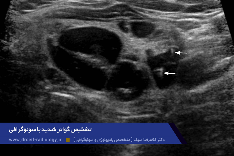 تشخیص گواتر شدید با سونوگرافی