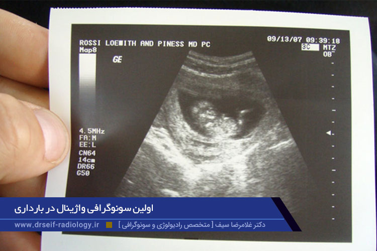 اولین سونوگرافی واژینال در بارداری