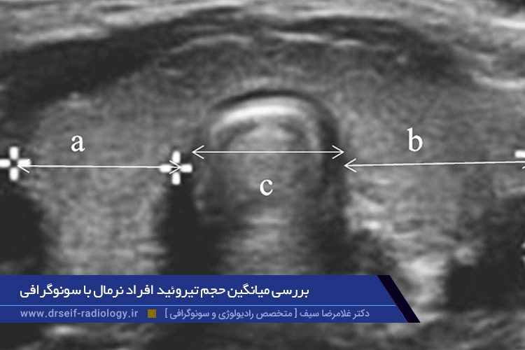 بررسی میانگین حجم تیروئید