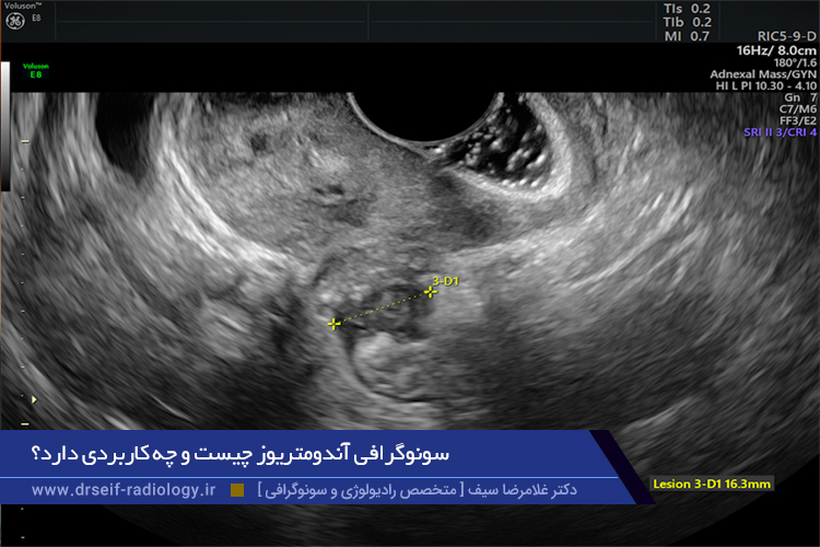 سونوگرافی آندومتریوز