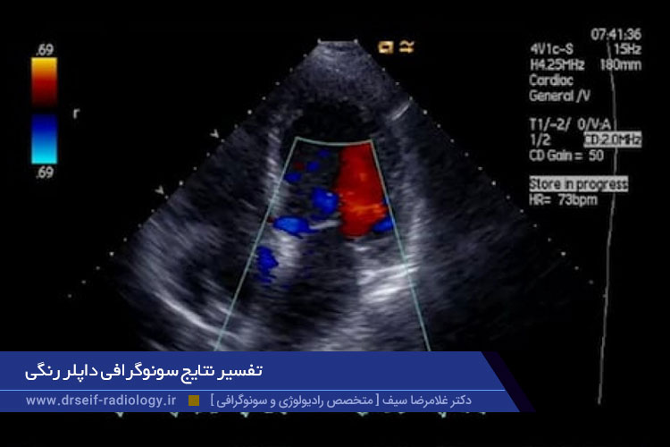 تفسیر نتایج سونوگرافی داپلر رنگی