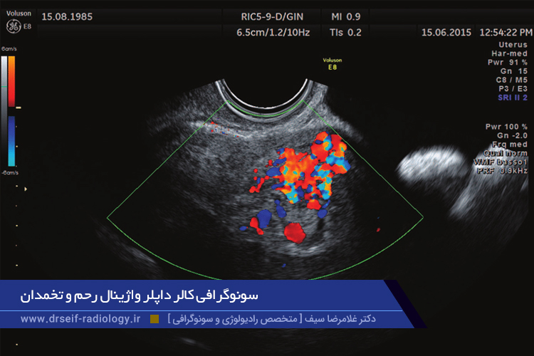 سونوگرافی کالر داپلر واژینال