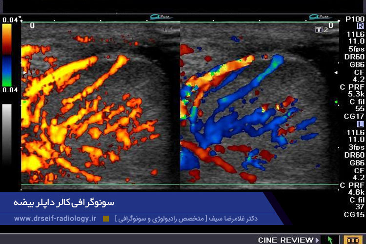 آمادگی برای سونوگرافی بیضه