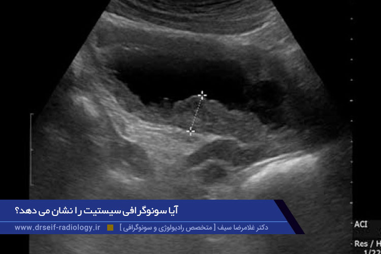 سونوگرافی سیستیت