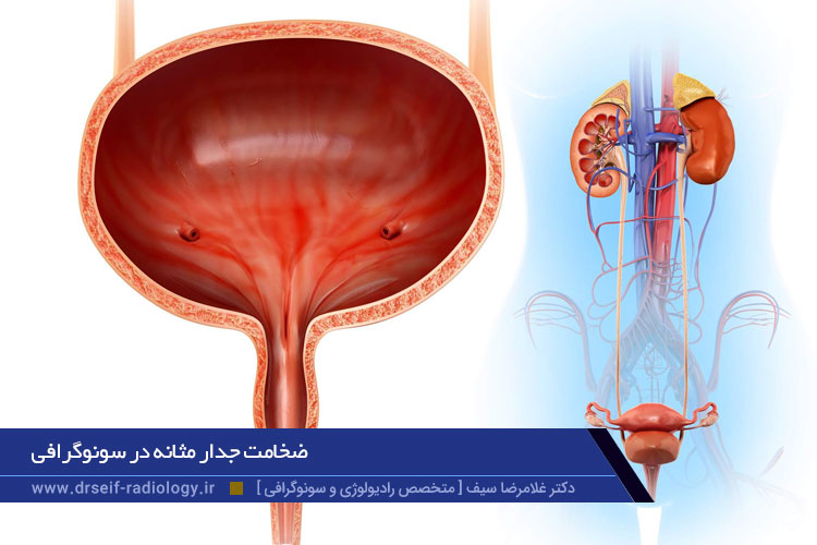 ضخامت جدار مثانه در سونوگرافی 