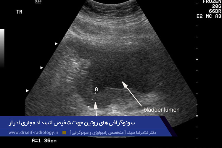 سونوگرافی های روتین جهت شخیص انسداد مجاری ادرار