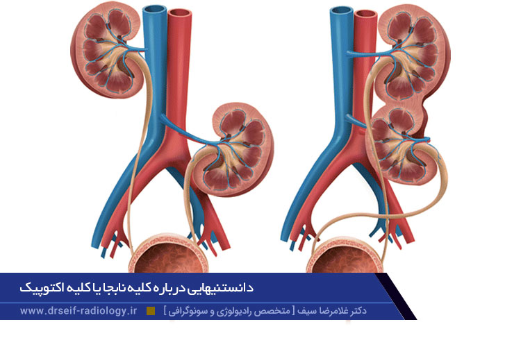 کلیه اکتوپیک