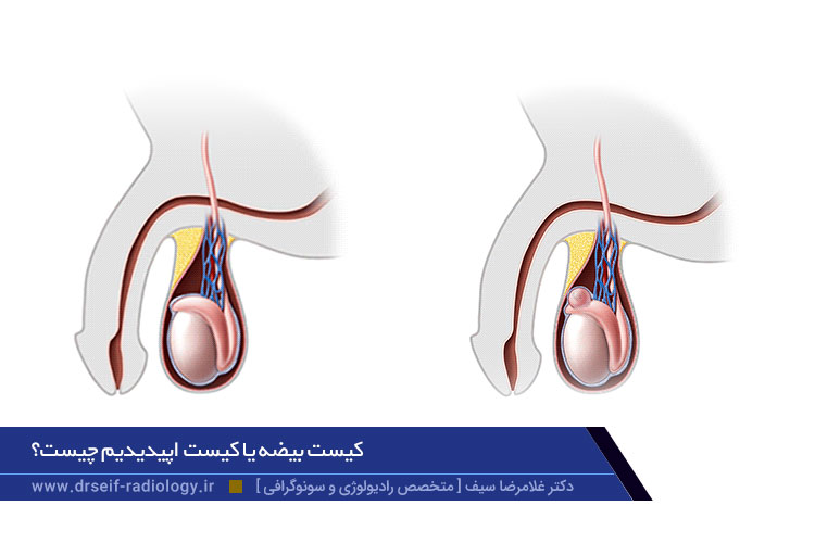 کیست بیضه