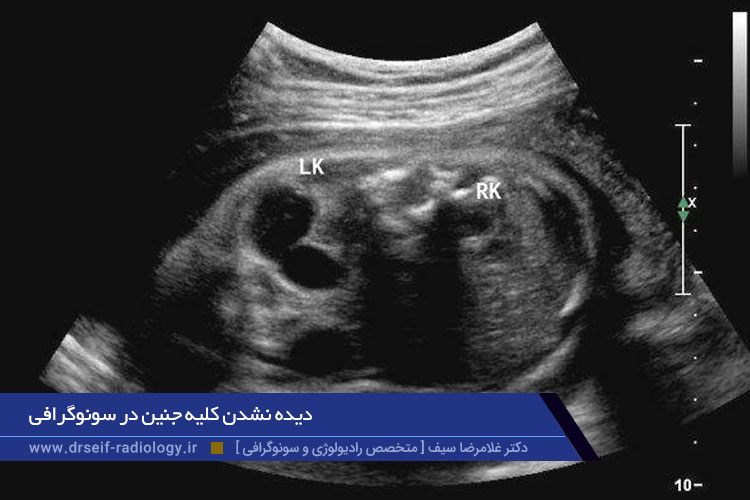 دیده نشدن کلیه جنین در سونوگرافی