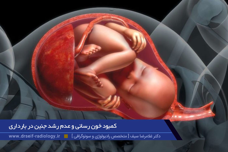 کمبود خون رسانی و عدم رشد جنین در بارداری