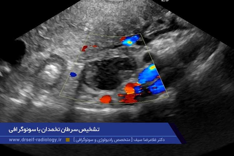 سونوگرافی سرطان تخمدان