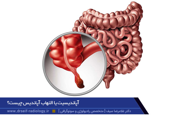 آپاندیسیت یا التهاب آپاندیس