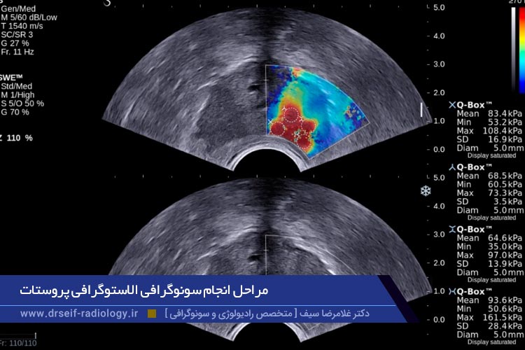 سونوگرافی الاستوگرافی پروستات