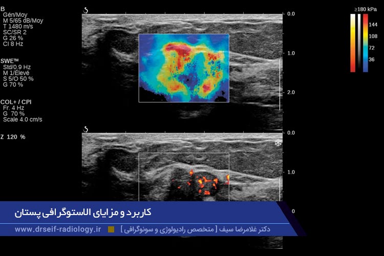 کاربرد و مزایای الاستوگرافی پستان