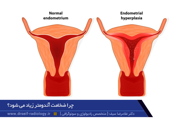 ضخامت آندومتر