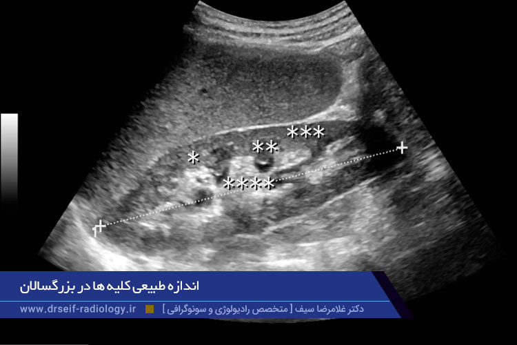 اندازه طبیعی کلیه ها در بزرگسالان