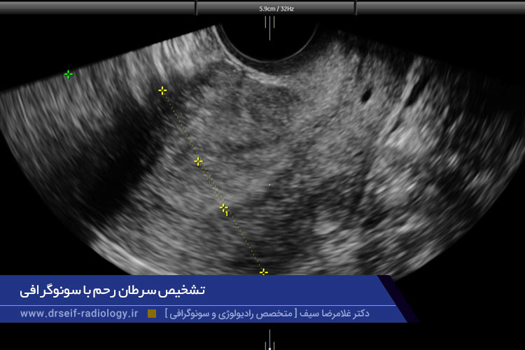 تشخیص سرطان رحم با سونوگرافی