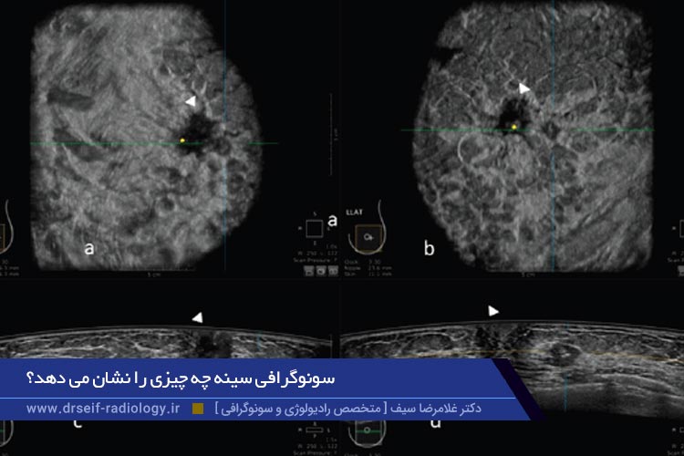 سونوگرافی سینه