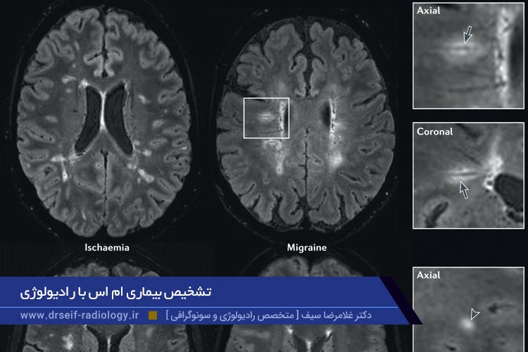 تشخیص بیماری ام اس با رادیولوژی