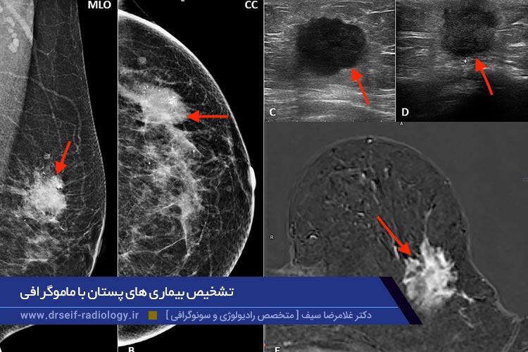 تشخیص بیماری های پستان با ماموگرافی