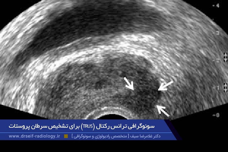 سونوگرافی ترانس رکتال