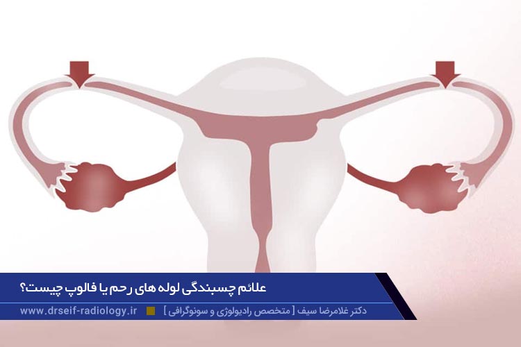 علائم چسبندگی لوله های رحم یا فالوپ