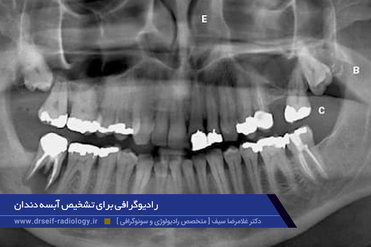 رادیوگرافی برای تشخیص آبسه دندان