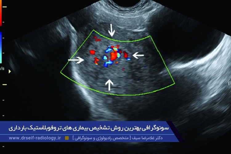 بیماری های تروفوبلاستیک بارداری