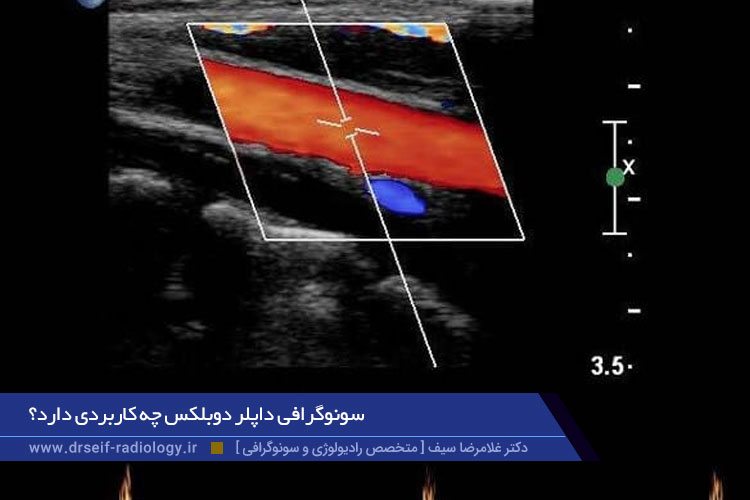 سونوگرافی داپلر دوبلکس