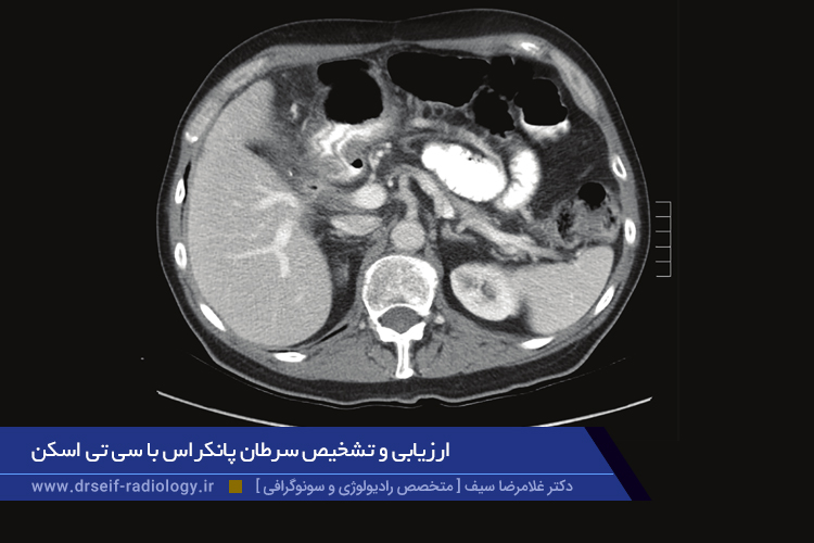 تشخیص سرطان پانکراس با سی تی اسکن