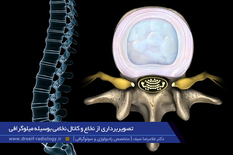 تصویربرداری از نخاع