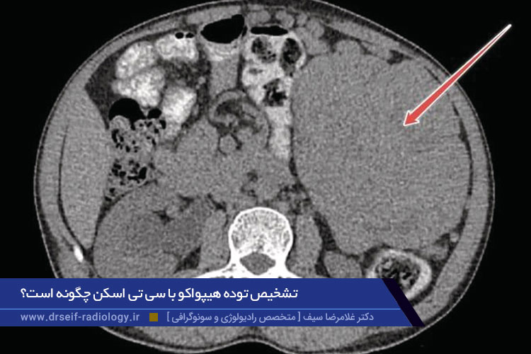 تشخیص توده هیپواکو