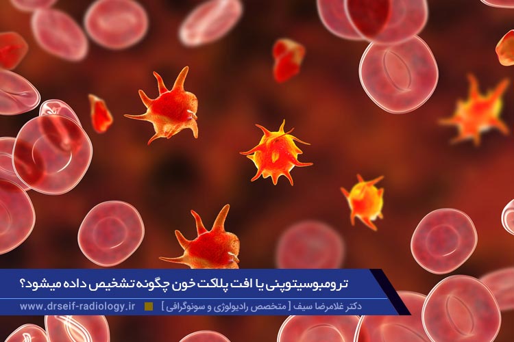 ترومبوسیتوپنی یا افت پلاکت خون
