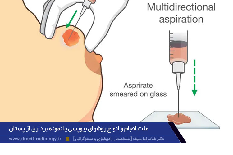 روشهای بیوپسی یا نمونه برداری از پستان