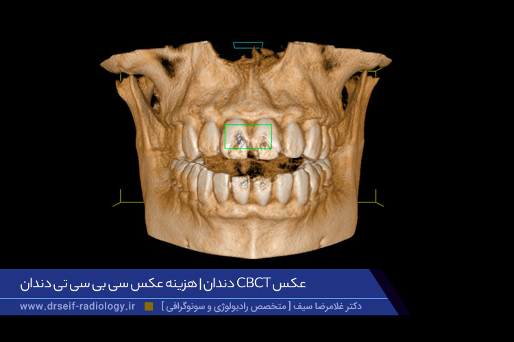 آمادگی قبل از انجام عکس سی بی سی تی دندان