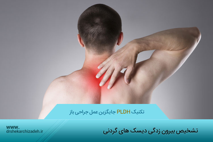 بیرون زدگی دیسک های گردنی