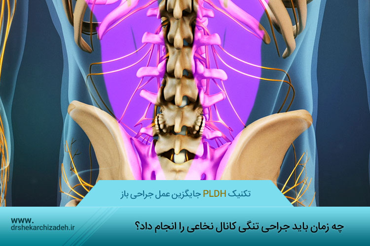 تنگی کانال نخاعی