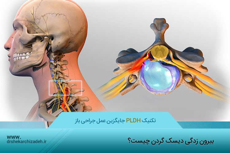 درمان بیرون زدگی دیسک گردن