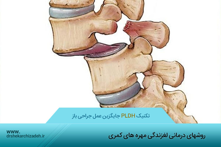 لغزندگی مهره های کمری